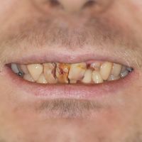 Dental Bridges before